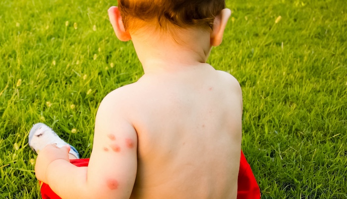 bébé avec de multiples piqures de moustiques et réaction allergiques